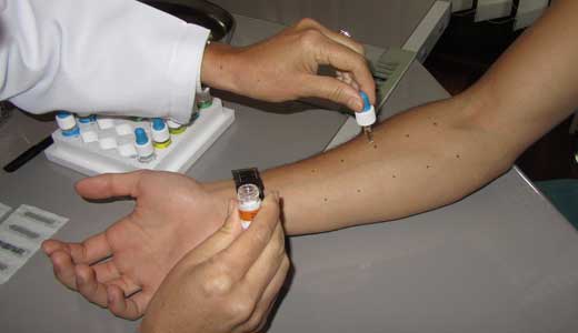 Pruebas de alergia (Prick-test)